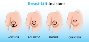 image in the text of types of breast lift scars