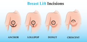 3 Types Of Breast Augmentation Incisions