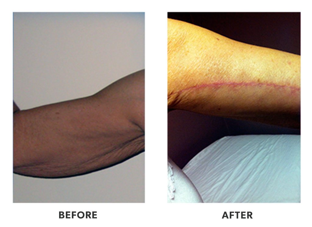 Before and after an armlift in Tijuana Mexico