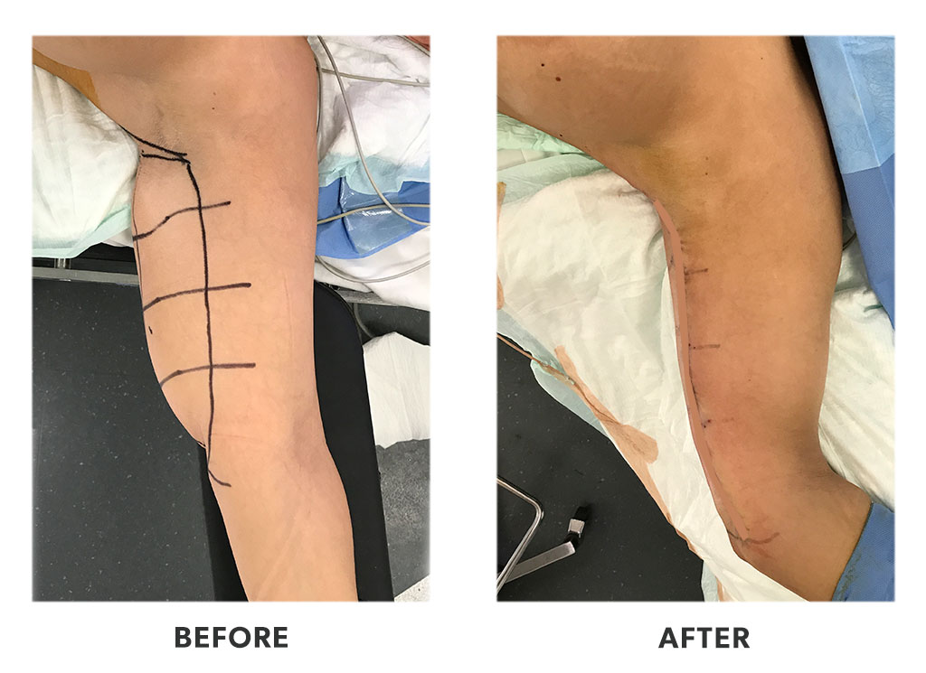 Before and after an armlift in Tijuana Mexico