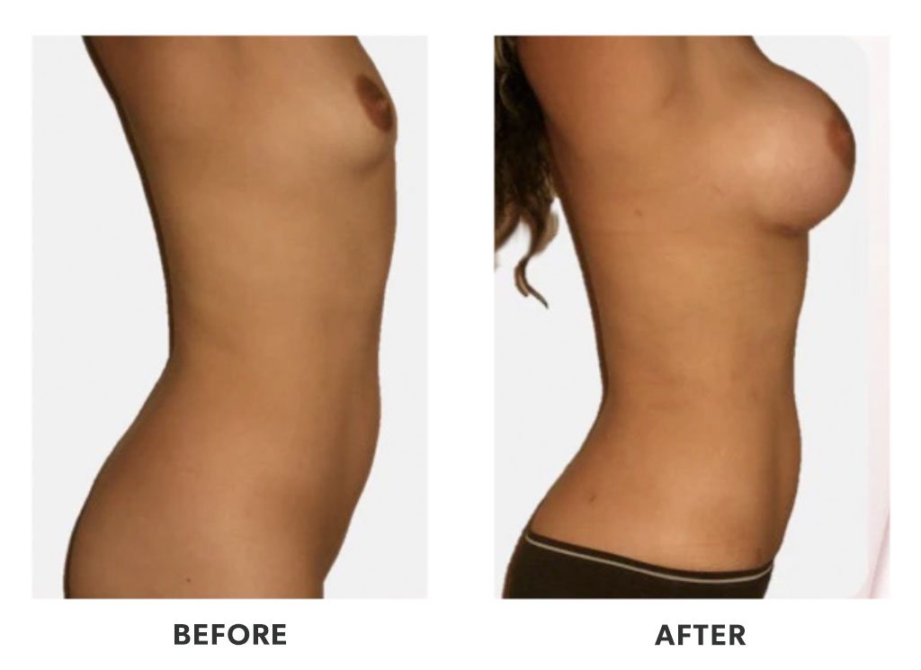 Before and after a breast augmentation in Tijuana Mexico