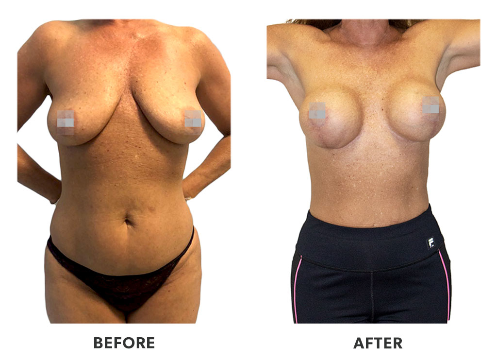 Before and after a breast augmentation in Tijuana Mexico