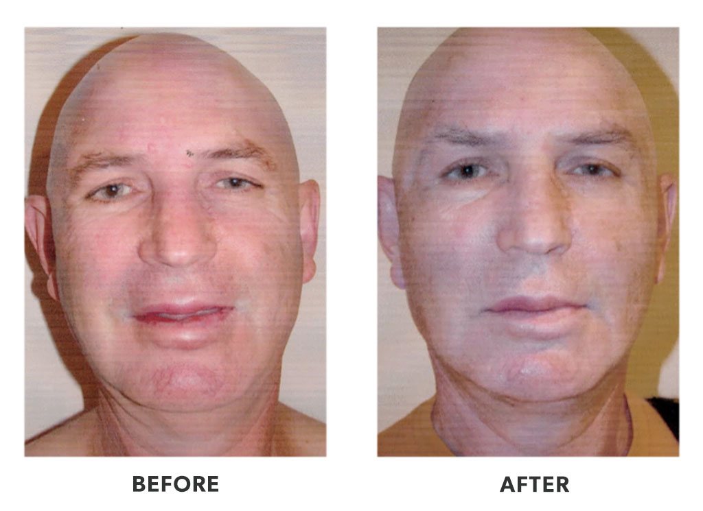 Get The Best Facelift In Tijuana Mexico Dr Luis Suarez Md