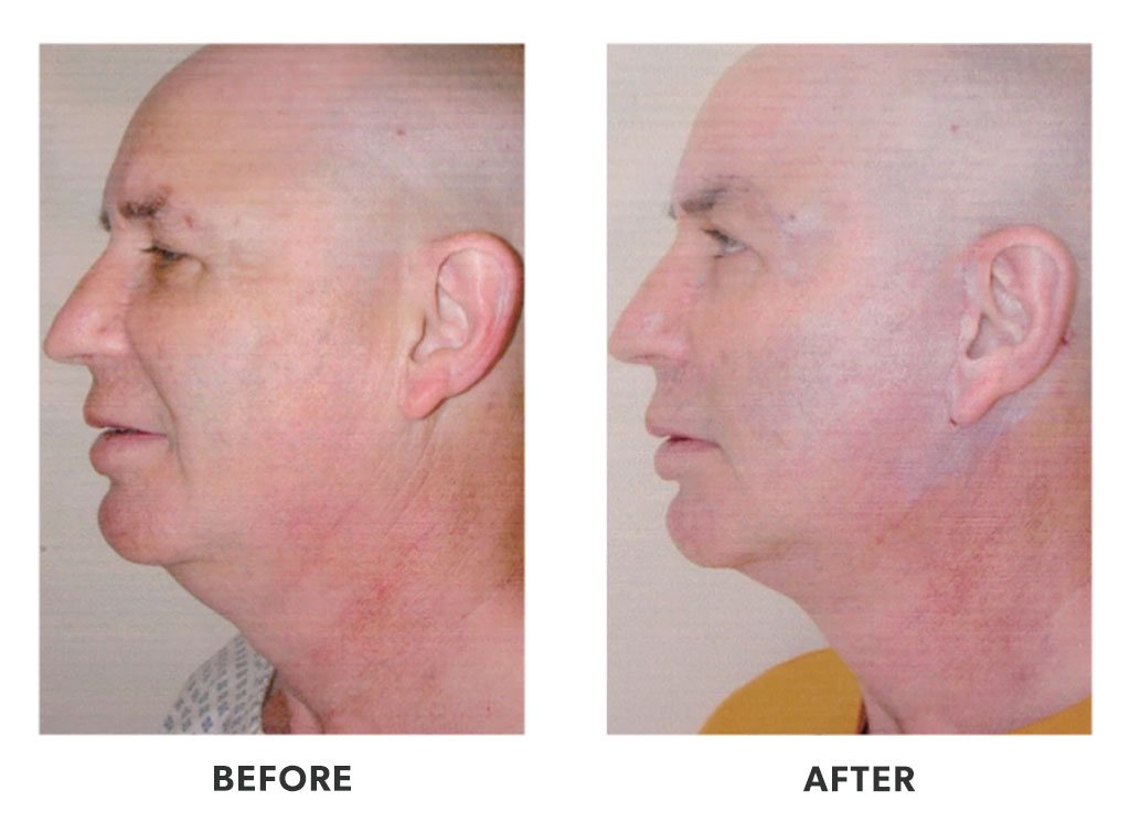 Before and after plastic surgery facelift