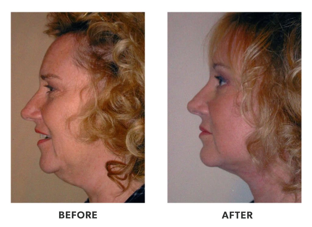 Before and after plastic surgery facelift