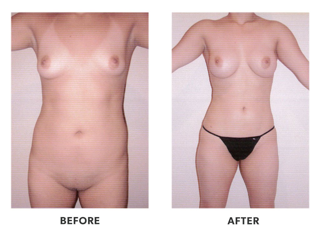 Before and after a liposuction in Tijuana Mexico