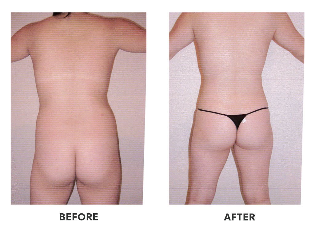 liposuctionprocedure2 Before and after a liposuction in Tijuana Mexico