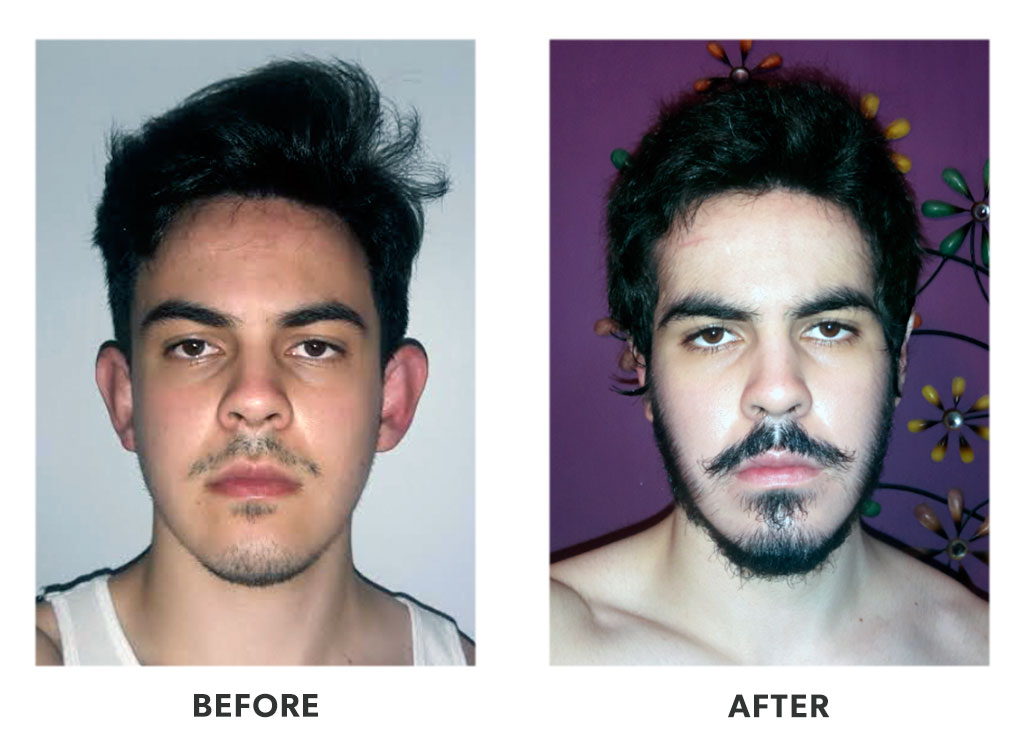 Before and after an otoplasty in Tijuana Mexico