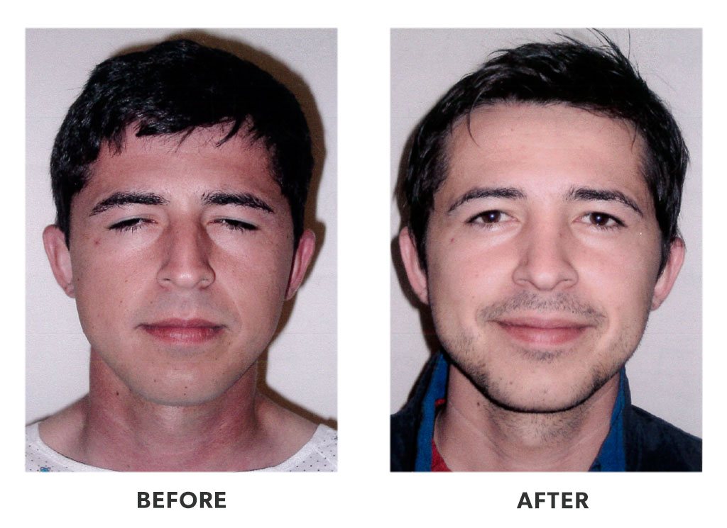 Before and after a rhinoplasty in Tijuana Mexico