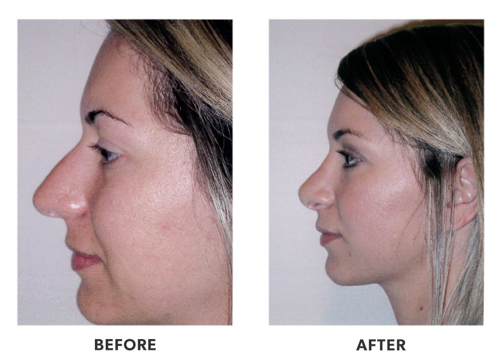 Before and after a rhinoplasty in Tijuana Mexico
