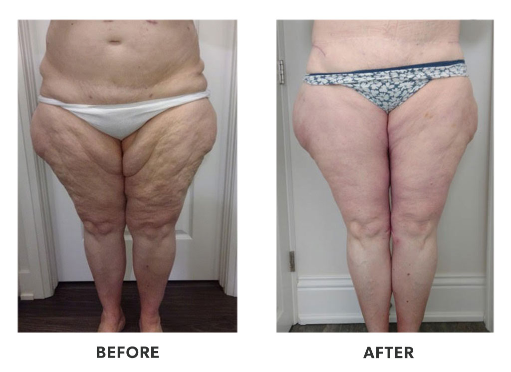 Are Inner Thighs Lifts Worth The Cost, Los Angeles? It's About