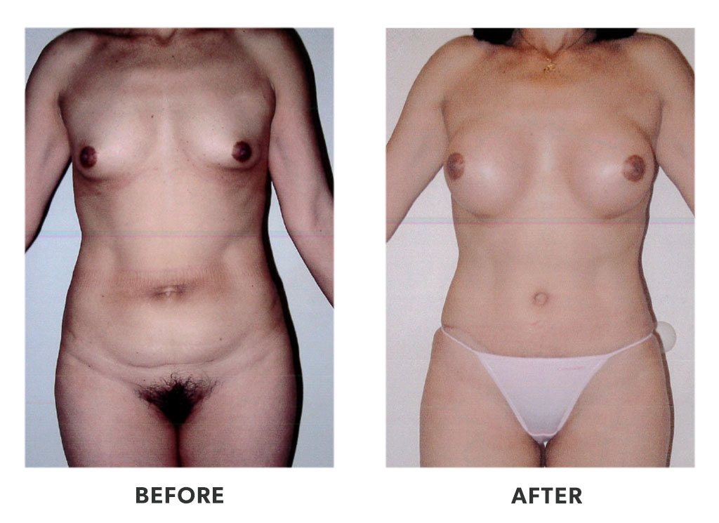 Before and after a tummy tuck in Tijuana Mexico