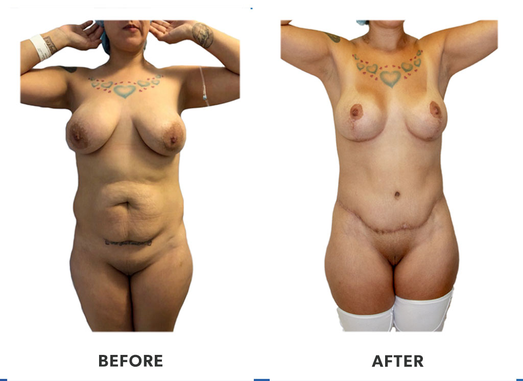 Before and after a tummy tuck in Tijuana Mexico