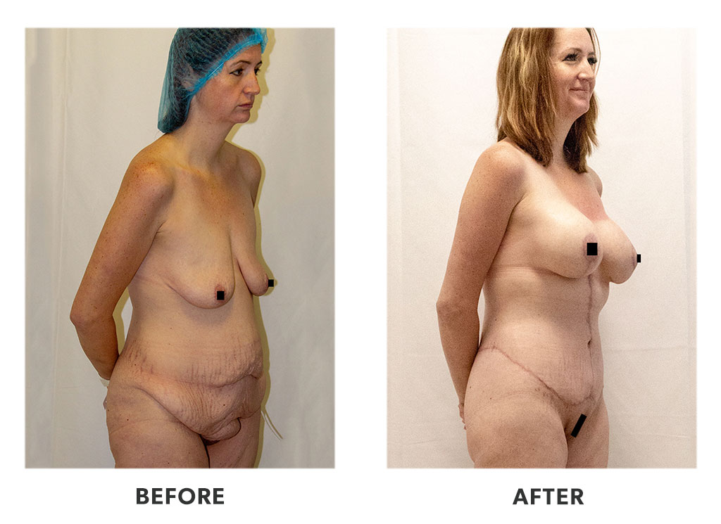 tummytuckprocedure21 Before and after a tummy tuck in Tijuana Mexico