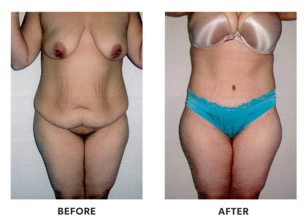 Before and after a tummy tuck in Tijuana Mexico