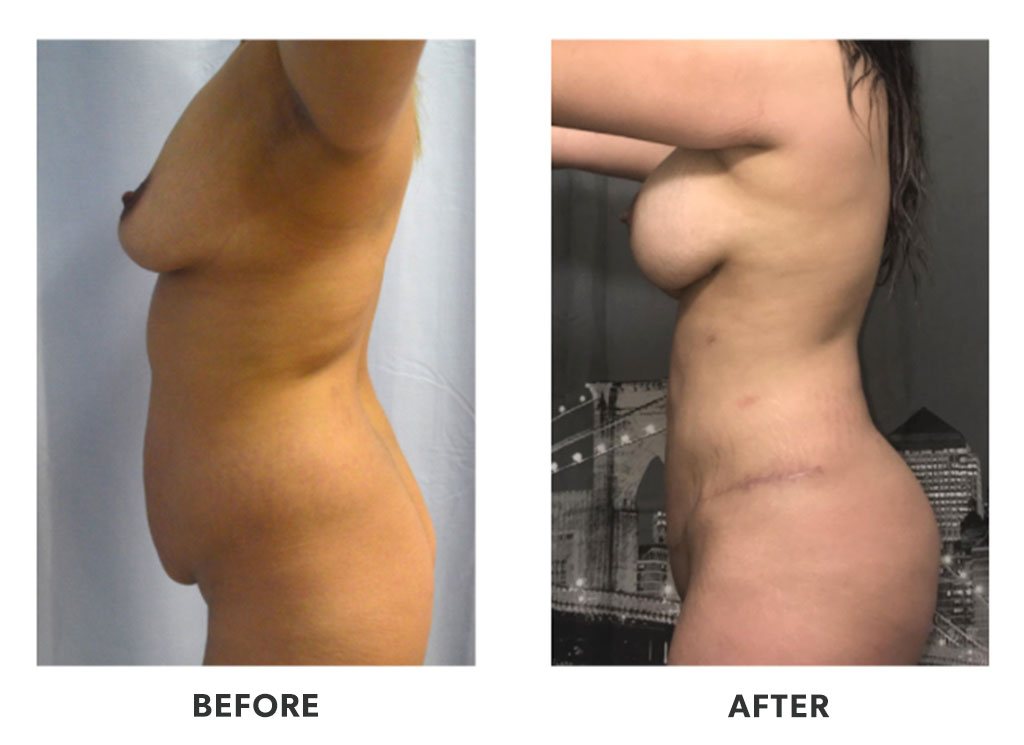 Before and after a tummy tuck in Tijuana Mexico