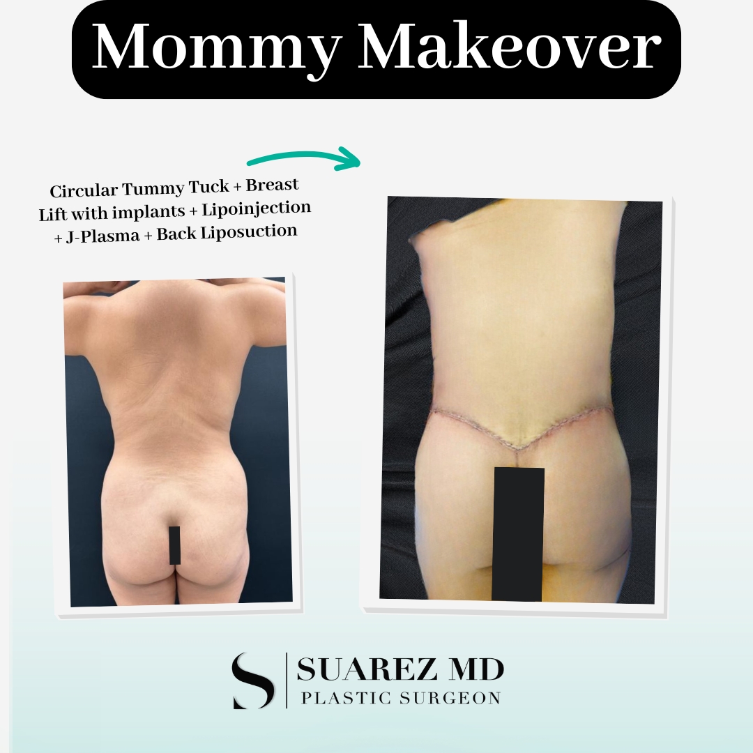 Sherry Lundsberg Mommy Makeover Back