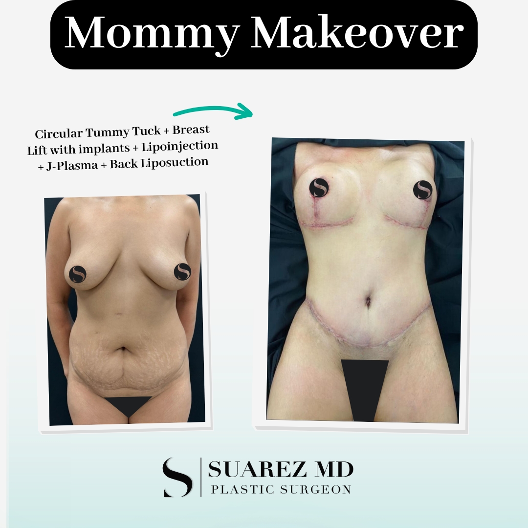Sherry Lundsberg Mommy Makeover Front