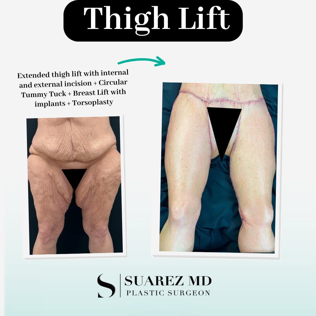 Toby Lynn Grimme Thigh Lift Front