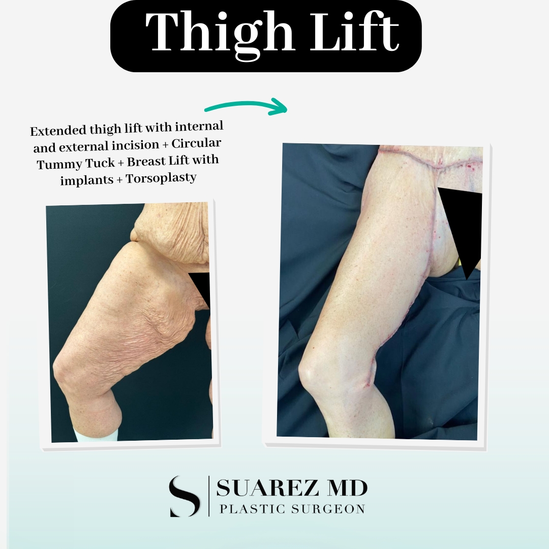 Toby Lynn Grimme Thigh Lift Other Side