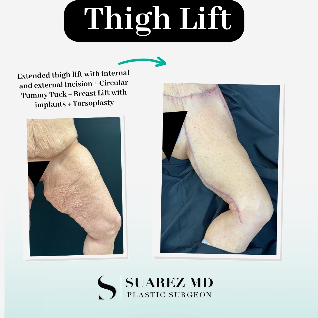 Toby Lynn Grimme Thigh Lift