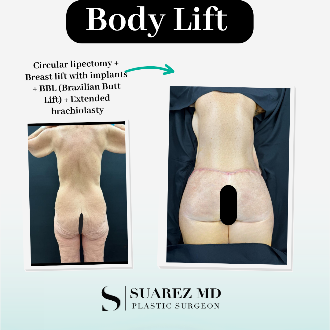 body lift circular lipectomy before and after back side before and after body lift surgery: circular lipectomy + breast lift with implants + BBL + Extended Brachioplasty tijuana mexico dr luis suarez - back side