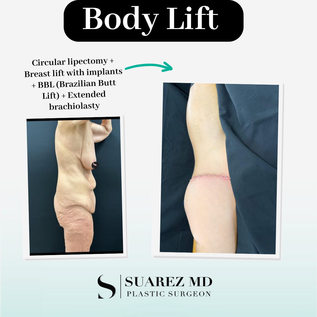 body lift circular lipectomy before and after left side before and after body lift surgery: circular lipectomy + breast lift with implants + BBL + Extended Brachioplasty tijuana mexico dr luis suarez - left side